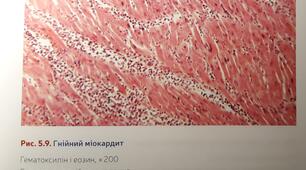 Розробка заняття "Запалення. Гарячка"